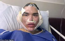 Gương mặt sưng phồng đáng sợ của Rodrigo Alves sau ca “dao kéo”