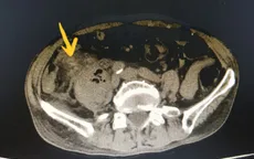 Cụ ông bị tăm xỉa răng đâm thủng ruột