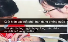 Những biểu hiện của bệnh thủy đậu