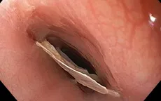Ăn cháo cá, bé 7 tuổi hóc phải mảnh xương có nhiều góc cạnh