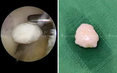 Loại bỏ mảnh sạn gây kẹt khớp gối