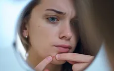 “Thất tình mọc mụn” có thật hay không?