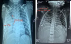 Hai bệnh viện nhi phối hợp cứu bé 5 tuổi tràn mủ, dính màng phổi phức tạp