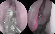 Thoát khỏi nguy cơ mù lòa vì phát hiện bệnh nguy hiểm khi khám sức khỏe tổng quát