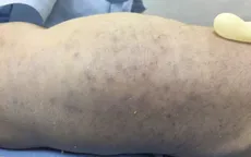 Trẻ sơ sinh tử vong nghi do nhiễm virus CMV