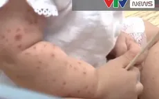 TP. Hồ Chí Minh: Báo động gia tăng số ca mắc tay chân miệng