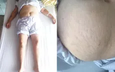 Lạm dụng corticoid - Tiền mất tật mang