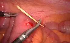 Đau bụng sau khi ăn phở, cô gái đi khám phát hiện thủng ruột non do nuốt phải tăm tre