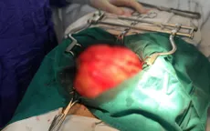 Tái phát khối ung thư kích cỡ lớn lần 2