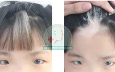 Tai điếc, mắt xanh bởi hội chứng hiếm gặp