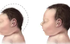 Nguyên nhân gây tật đầu nhỏ ở trẻ sơ sinh?