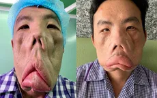 Tìm ra căn bệnh cho chàng trai suốt 15 năm mang thân phận "mặt quỷ"