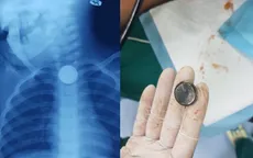 Bé 2 tuổi bỏng thực quản do nuốt pin cúc áo