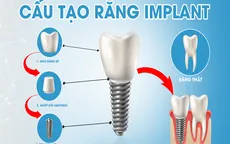 Chọn phương pháp trồng răng giả giá rẻ có an toàn hay không?