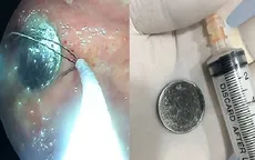 Gắp đồng xu trong dạ dày bé gái 4 tuổi
