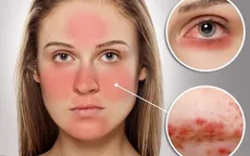 Chương trình nghiên cứu gene quy mô lớn về bệnh lupus ban đỏ tại châu Á