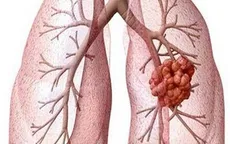 Liệu pháp nhắm trúng đích trong điều trị ung thư phổi