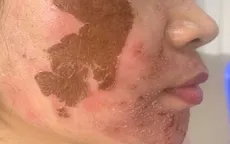 Dùng thuốc trị nám không rõ nguồn gốc, nhiều phụ nữ bị biến chứng