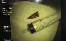 Hy hữu: Lấy mảnh ớt dài 2cm nằm trong... phế quản