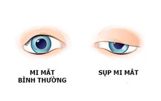 Châm cứu phục hồi triệu chứng sụp mí sau chấn thương