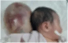 Bé sơ sinh mang khối thoát vị "khổng lồ" sau đầu