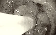 Xuất huyết tiêu hóa, hẹp môn vị do bã thức ăn