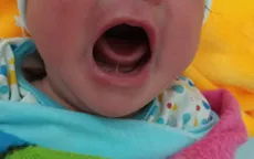 Dính thắng lưỡi ở trẻ sơ sinh có nguy hiểm?