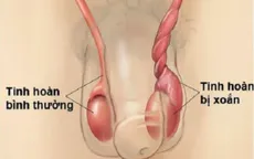 Xoắn tinh hoàn - Bệnh lý không thể chủ quan