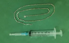 Lấy sợi dây chuyền dài gần 40 cm trong dạ dày của bé 2 tuổi