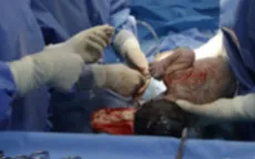 Truyền 15 đơn vị máu cứu sống sản phụ ngừng tim, ngừng thở, rối loạn đông máu