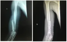 Hy hữu: Nam thanh niên gãy xương cánh tay vì... chơi trò vật tay