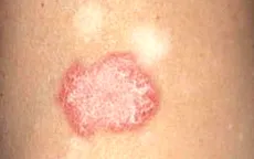 Những điều nên làm khi mắc lupus ban đỏ