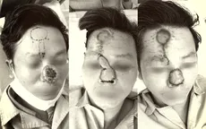 Từ mụn nhỏ trên mũi không gây đau đớn, phát triển thành khối ung thư