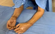 Cứu người đàn ông đứt rời 2 bàn tay, vết thương sọ não