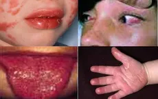COVID-19 gây biến chứng chết người ở trẻ nhỏ