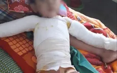Chơi bật lửa, bé trai bị lửa bén cháy quần áo gây bỏng nặng