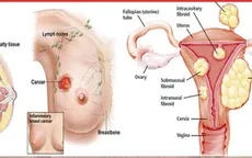TPBVSK Tiêu Mộc Vương – hỗ trợ giảm sự phát triển của u xơ ở phụ nữ