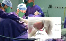 Phương pháp TOT - Xóa mặc cảm són tiểu ở phụ nữ