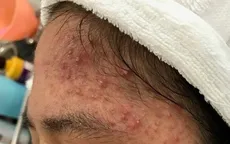 Các bệnh da liễu thường gặp vào mùa hè