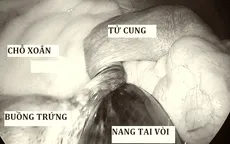 Cẩn trọng với xoắn buồng trứng ở bé gái