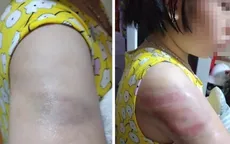 Cô đánh trò bầm tím tay vì viết chậm: Điều không nên xảy ra ở trường học