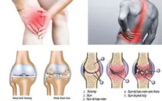 Thực phẩm bảo vệ sức khỏe viên xương khớp An Khớp Xà