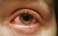 Mắt đỏ có thể là triệu chứng điển hình của COVID-19