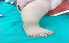 Hy hữu: Bé trai 1 tuổi bàn chân phải có 9 ngón