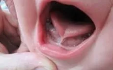 Con chậm nói, nói ngọng... - coi chừng mắc phải dị tật này!