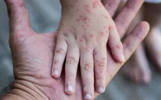 WHO công bố Sri Lanka và Maldives đã thanh toán được bệnh sởi và rubella