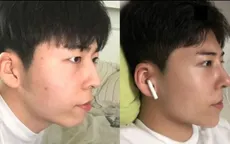 Nam sinh Hàn Quốc phẫu thuật thẩm mỹ để giống Park Bo Gum