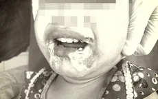 Cắn dây điện, bé gái 2 tuổi bị bỏng nặng vùng miệng