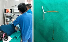 Vòng tránh thai "đi lạc" vào đại tràng
