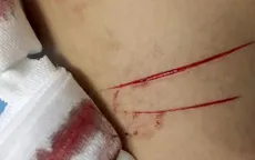 TP.HCM: Lại xuất hiện vụ rạch đùi nữ sinh trên đường đi học về